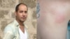 Frank Andrés Mora y la herida en su espalda causada por un asaltante. (Facebook).